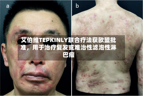 艾伯维TEPKINLY联合疗法获欧盟批准，用于治疗复发或难治性滤泡性淋巴瘤-第3张图片